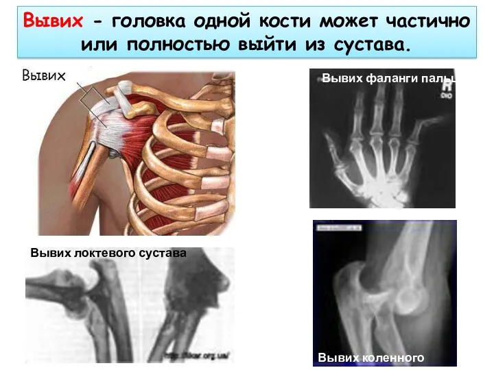 Вывих - головка одной кости может частично или полностью выйти