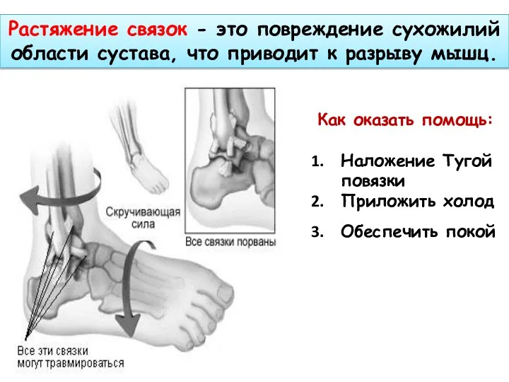 Растяжение связок - это повреждение сухожилий области сустава, что приводит