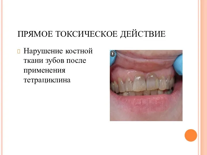 ПРЯМОЕ ТОКСИЧЕСКОЕ ДЕЙСТВИЕ Нарушение костной ткани зубов после применения тетрациклина