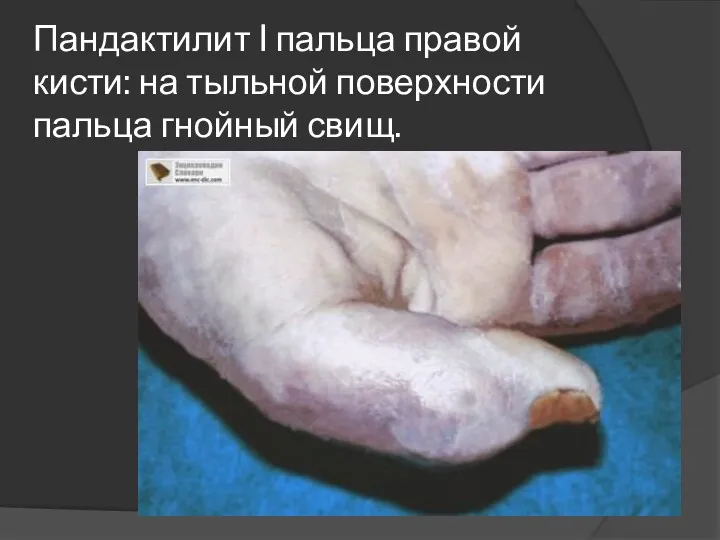 Пандактилит I пальца правой кисти: на тыльной поверхности пальца гнойный свищ.