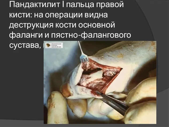 Пандактилит I пальца правой кисти: на операции видна деструкция кости основной фаланги и