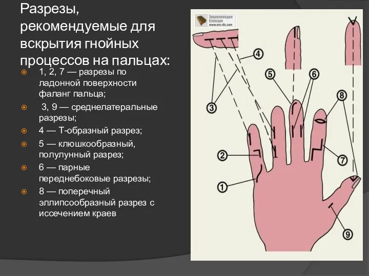 Разрезы, рекомендуемые для вскрытия гнойных процессов на пальцах: 1, 2, 7 — разрезы