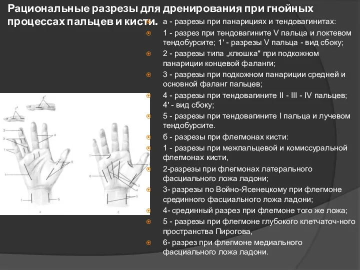 Рациональные разрезы для дренирования при гнойных процессах пальцев и кисти. а - разрезы