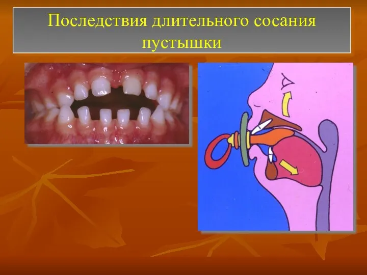 Последствия длительного сосания пустышки