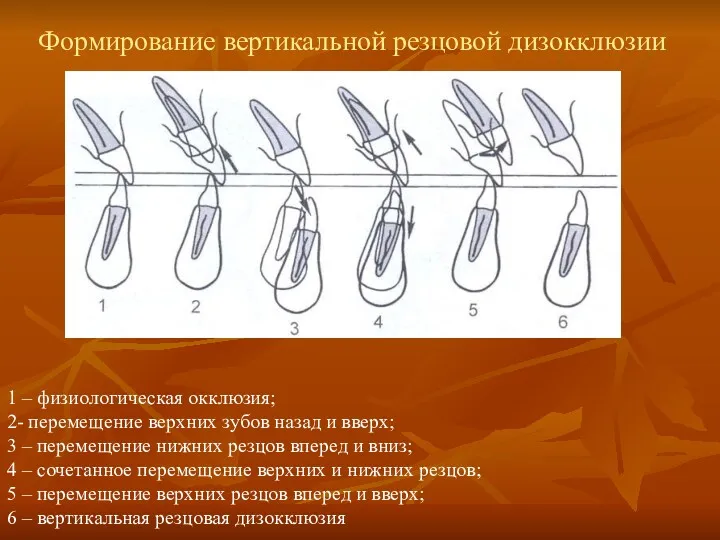 1 – физиологическая окклюзия; 2- перемещение верхних зубов назад и