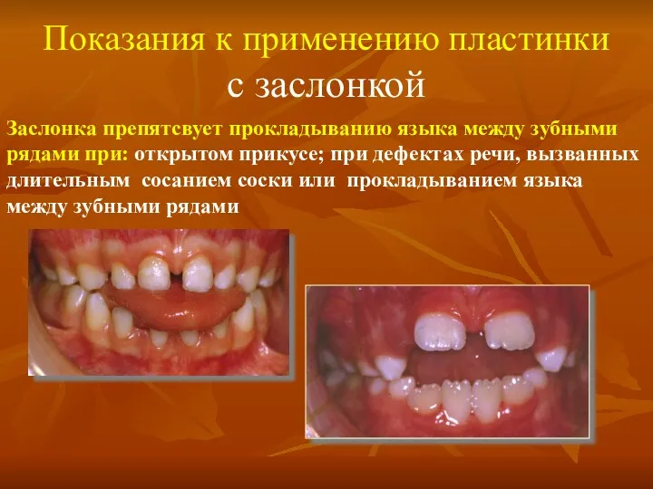 Показания к применению пластинки с заслонкой Заслонка препятсвует прокладыванию языка между зубными рядами