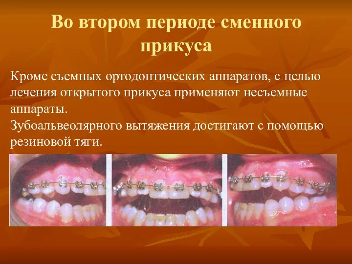 Кроме съемных ортодонтических аппаратов, с целью лечения открытого прикуса применяют