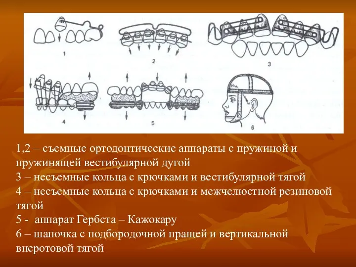 1,2 – съемные ортодонтические аппараты с пружиной и пружинящей вестибулярной