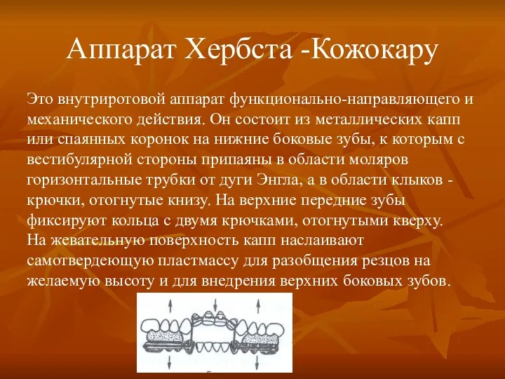 Аппарат Хербста -Кожокару Это внутриротовой аппарат функционально-направляющего и механического действия.