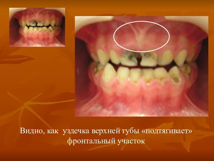 Видно, как уздечка верхней губы «подтягивает» фронтальный участок