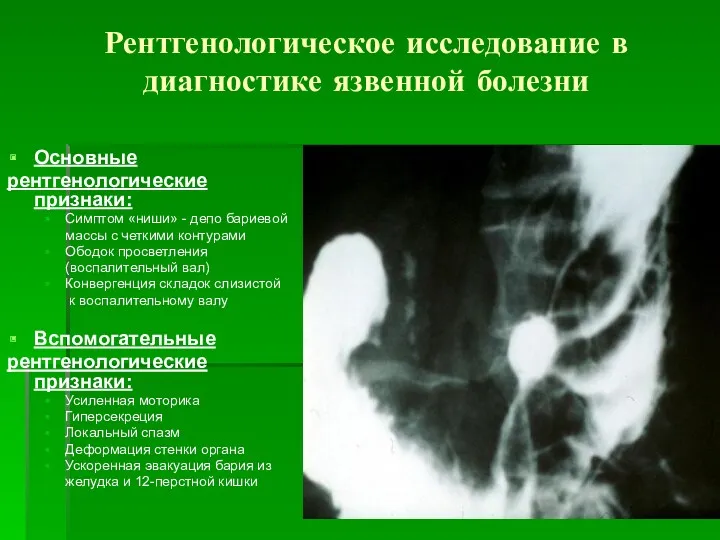 Рентгенологическое исследование в диагностике язвенной болезни Основные рентгенологические признаки: Симптом