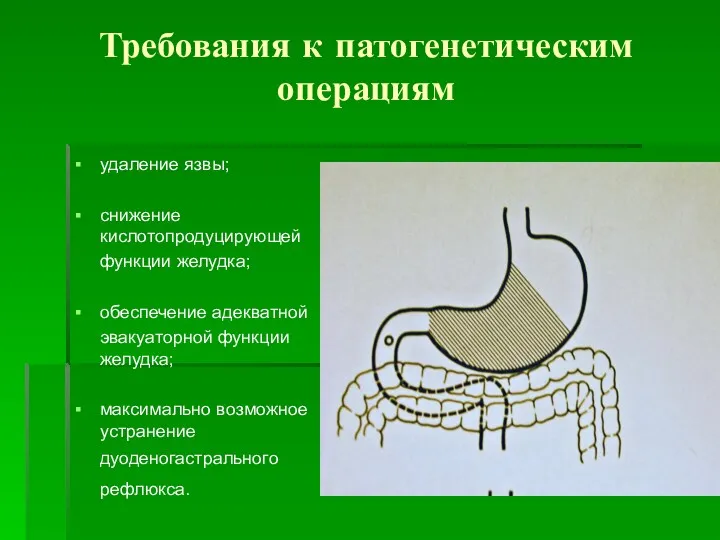 Требования к патогенетическим операциям удаление язвы; снижение кислотопродуцирующей функции желудка;