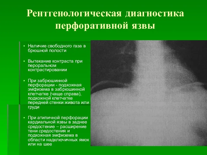 Рентгенологическая диагностика перфоративной язвы Наличие свободного газа в брюшной полости