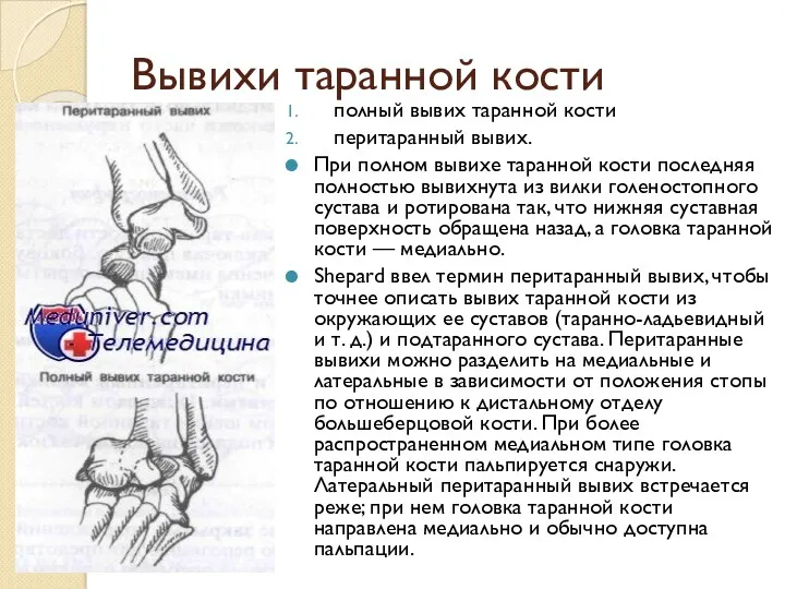 Вывихи таранной кости полный вывих таранной кости перитаранный вывих. При