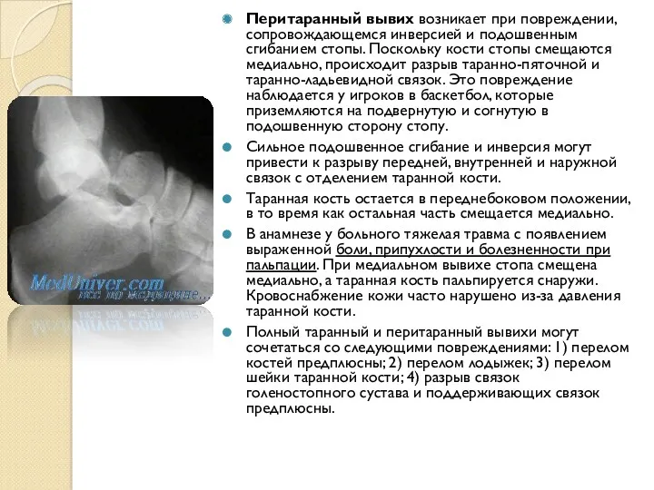 Перитаранный вывих возникает при повреждении, сопровождающемся инверсией и подошвенным сгибанием