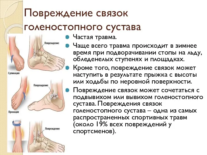 Повреждение связок голеностопного сустава Частая травма. Чаще всего травма происходит