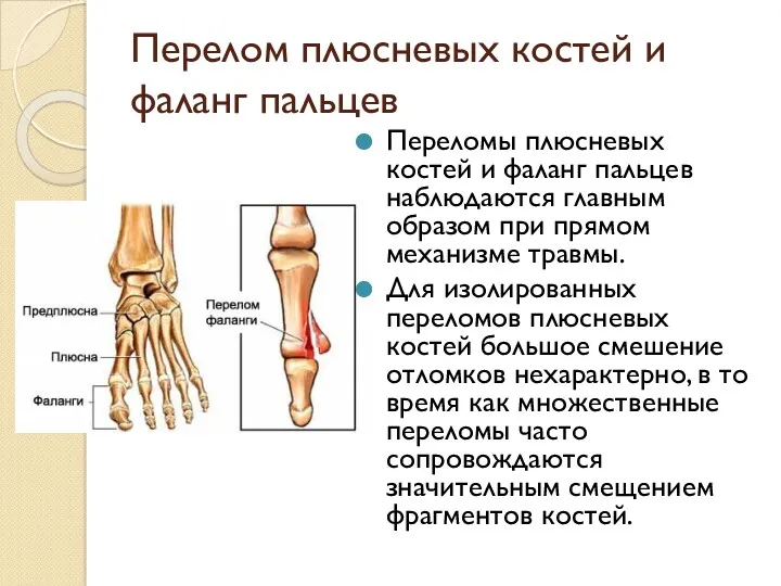 Перелом плюсневых костей и фаланг пальцев Переломы плюсневых костей и