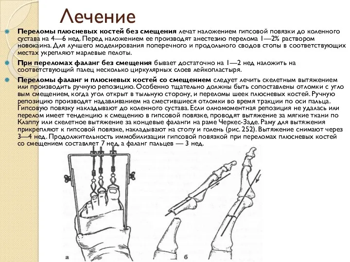 Лечение Переломы плюсневых костей без смещения лечат наложением гипсовой повязки