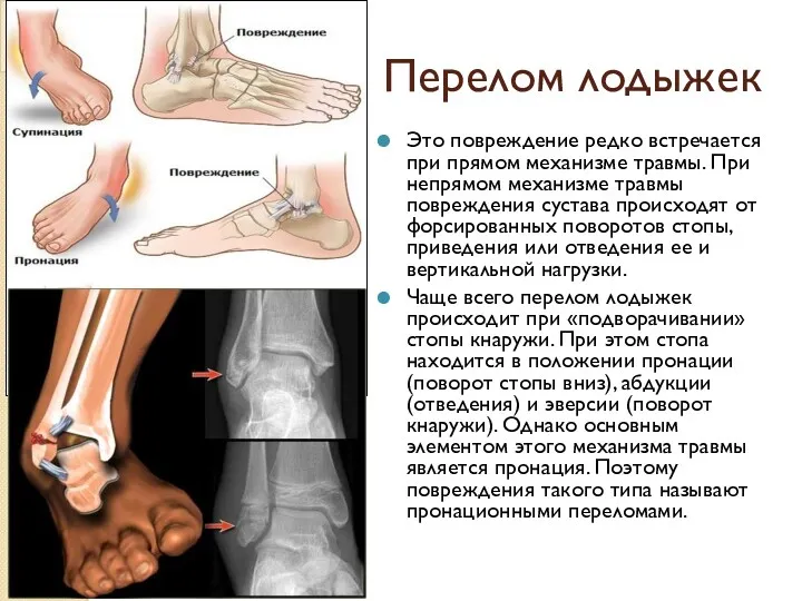 Перелом лодыжек Это повреждение редко встречается при прямом механизме травмы.