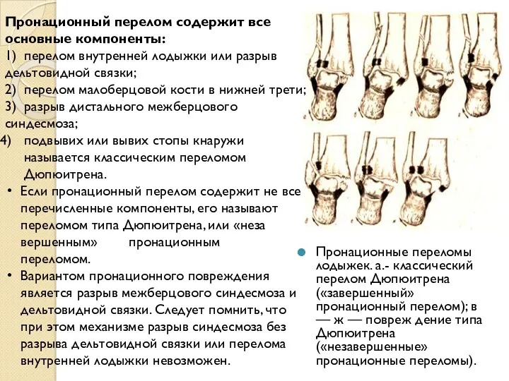 Пронационные переломы лодыжек. а.- классический перелом Дюпюитрена («завершенный» пронационный перелом);