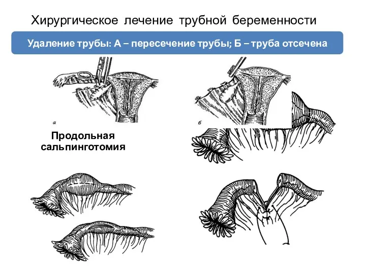 Хирургическое лечение трубной беременности Продольная сальпинготомия Сегментарная резекция трубы Удаление