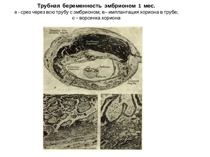 Трубная беременность эмбрионом 1 мес. а - срез через всю