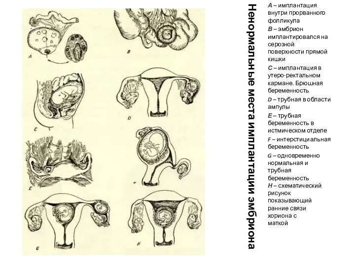 Ненормальные места имплантации эмбриона А – имплантация внутри прорванного фолликула