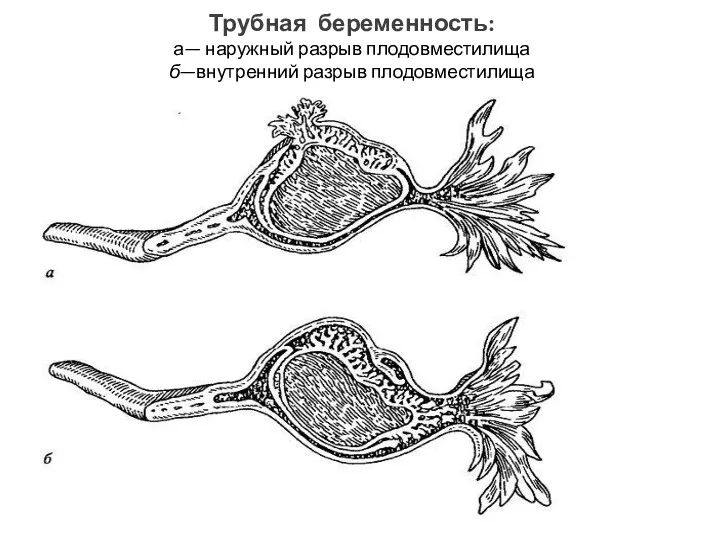 Трубная беременность: а— наружный разрыв плодовместилища б—внутренний разрыв плодовместилища