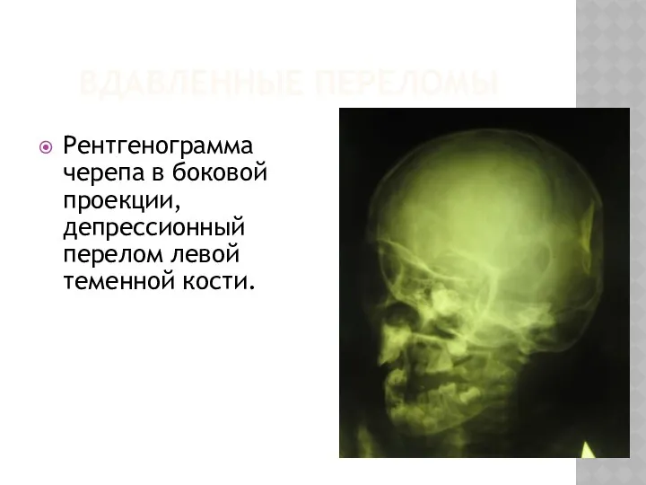 ВДАВЛЕННЫЕ ПЕРЕЛОМЫ Рентгенограмма черепа в боковой проекции, депрессионный перелом левой теменной кости.