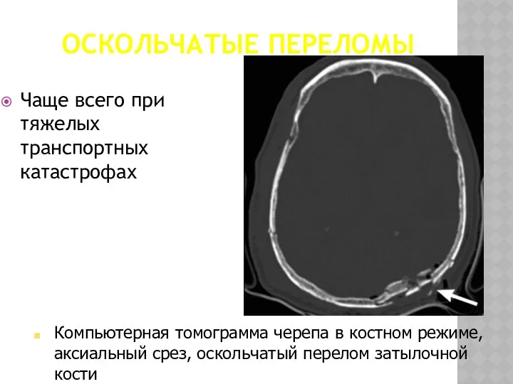 ОСКОЛЬЧАТЫЕ ПЕРЕЛОМЫ Чаще всего при тяжелых транспортных катастрофах Компьютерная томограмма черепа в костном