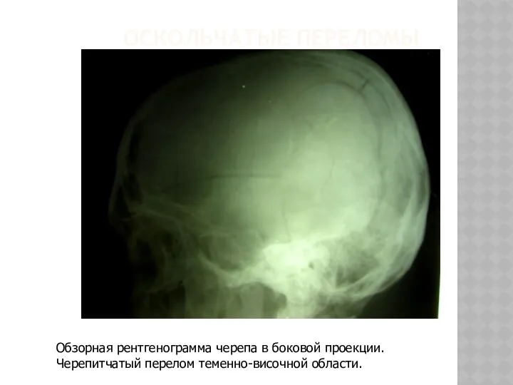 ОСКОЛЬЧАТЫЕ ПЕРЕЛОМЫ Обзорная рентгенограмма черепа в боковой проекции. Черепитчатый перелом теменно-височной области.