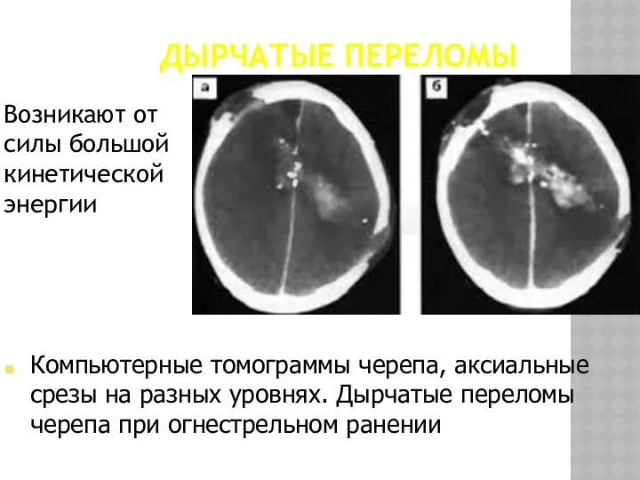 ДЫРЧАТЫЕ ПЕРЕЛОМЫ Возникают от силы большой кинетической энергии Компьютерные томограммы