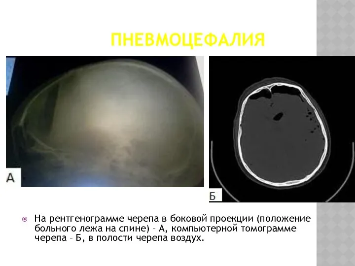ПНЕВМОЦЕФАЛИЯ На рентгенограмме черепа в боковой проекции (положение больного лежа на спине) –