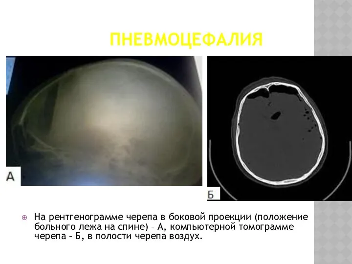 ПНЕВМОЦЕФАЛИЯ На рентгенограмме черепа в боковой проекции (положение больного лежа