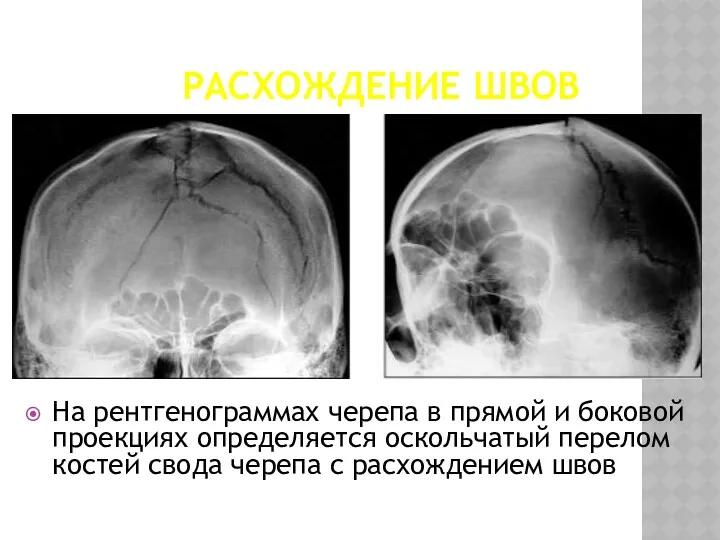 РАСХОЖДЕНИЕ ШВОВ На рентгенограммах черепа в прямой и боковой проекциях определяется оскольчатый перелом