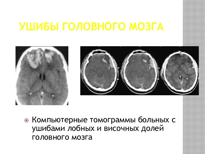 УШИБЫ ГОЛОВНОГО МОЗГА Компьютерные томограммы больных с ушибами лобных и височных долей головного мозга