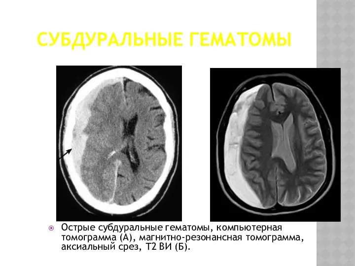 СУБДУРАЛЬНЫЕ ГЕМАТОМЫ Острые субдуральные гематомы, компьютерная томограмма (А), магнитно-резонансная томограмма, аксиальный срез, Т2 ВИ (Б).