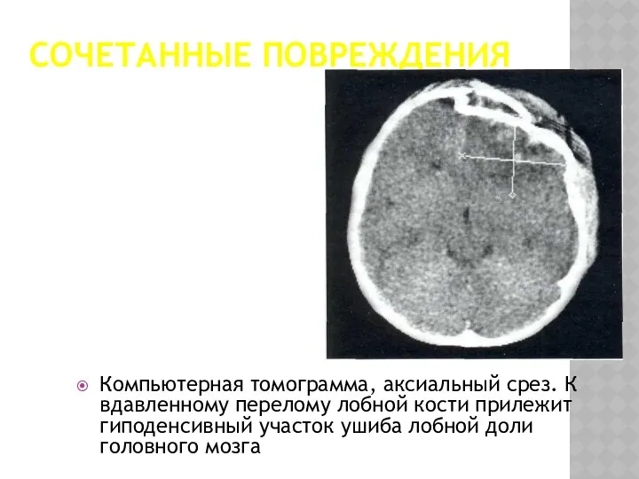 СОЧЕТАННЫЕ ПОВРЕЖДЕНИЯ Компьютерная томограмма, аксиальный срез. К вдавленному перелому лобной кости прилежит гиподенсивный