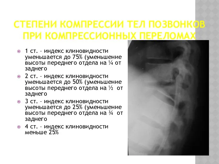 СТЕПЕНИ КОМПРЕССИИ ТЕЛ ПОЗВОНКОВ ПРИ КОМПРЕССИОННЫХ ПЕРЕЛОМАХ 1 ст. –