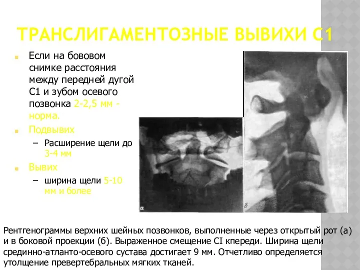 ТРАНСЛИГАМЕНТОЗНЫЕ ВЫВИХИ С1 Рентгенограммы верхних шейных позвонков, выполненные через открытый рот (а) и
