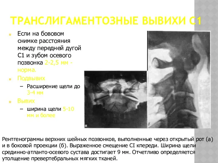 ТРАНСЛИГАМЕНТОЗНЫЕ ВЫВИХИ С1 Рентгенограммы верхних шейных позвонков, выполненные через открытый