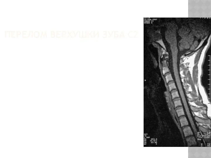 ПЕРЕЛОМ ВЕРХУШКИ ЗУБА C2