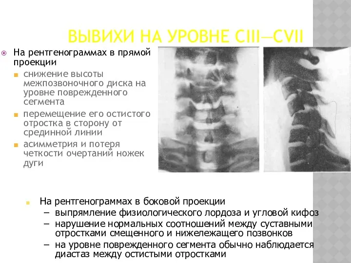 ВЫВИХИ НА УРОВНЕ CIII—CVII На рентгенограммах в прямой проекции снижение