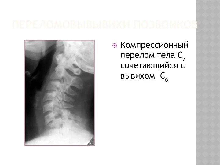 ПЕРЕЛОМОВЫВЫВИХИ ПОЗВОНКОВ Компрессионный перелом тела С7 сочетающийся с вывихом С6