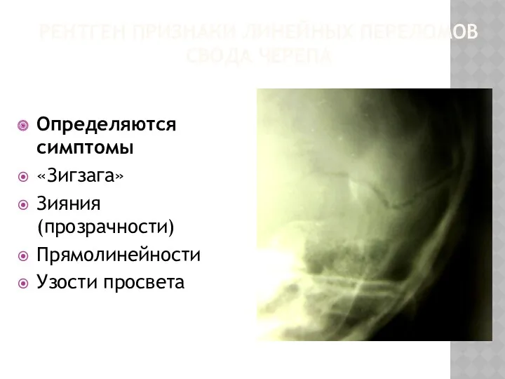 РЕНТГЕН ПРИЗНАКИ ЛИНЕЙНЫХ ПЕРЕЛОМОВ СВОДА ЧЕРЕПА Определяются симптомы «Зигзага» Зияния (прозрачности) Прямолинейности Узости просвета