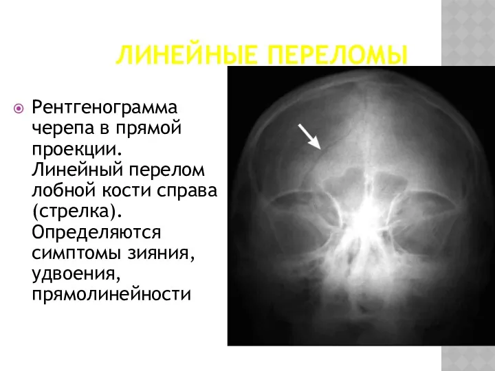 ЛИНЕЙНЫЕ ПЕРЕЛОМЫ Рентгенограмма черепа в прямой проекции. Линейный перелом лобной кости справа (стрелка).