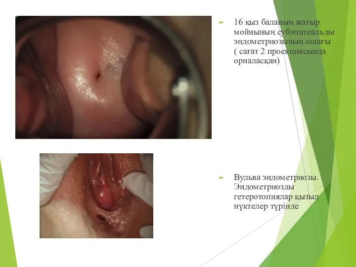 16 қыз баланың жатыр мойнының субэпитеальды эндометриозының ошағы ( сағат