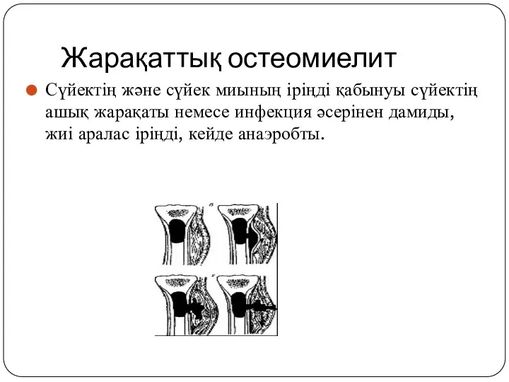 Жарақаттық остеомиелит Сүйектің және сүйек миының іріңді қабынуы сүйектің ашық