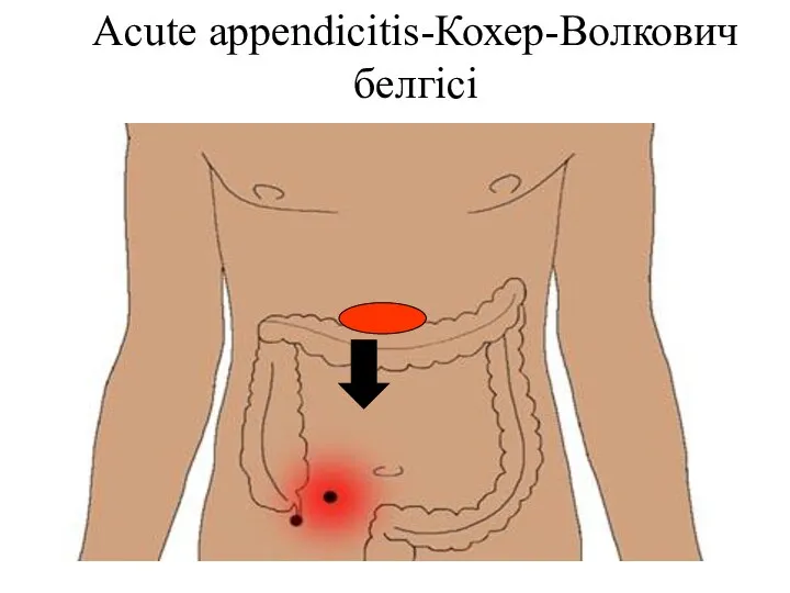 Acute appendicitis-Кохер-Волкович белгісі