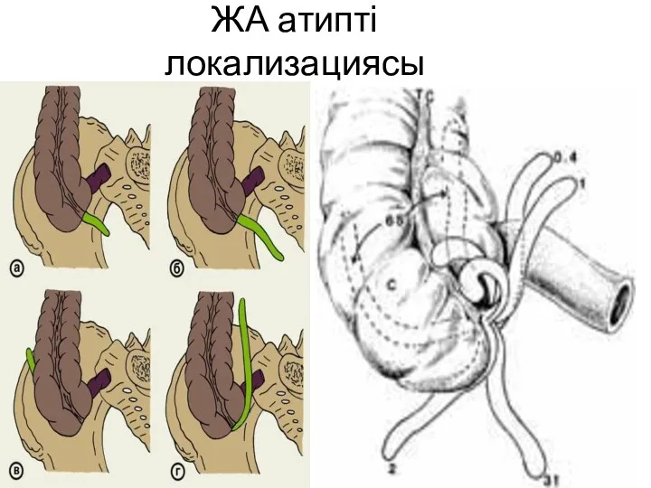 ЖА атипті локализациясы